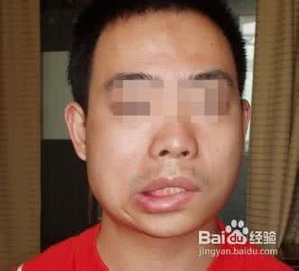 面瘫早期症状有哪些 得面瘫有什么症状 面瘫的早期症状有哪些