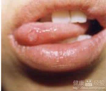 治疗口腔溃疡小偏方 七个治疗口腔溃疡的小偏方