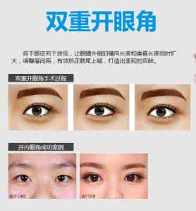 双眼皮开眼角恢复时间 开眼角 埋线双眼皮的恢复时间