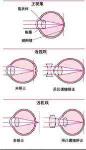 屈光性近视 轴性近视屈光性近视的区别