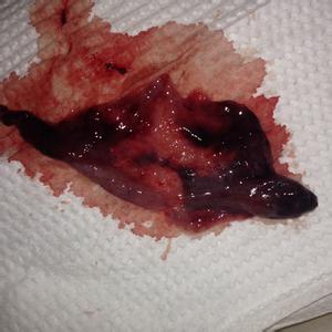 药流后最快多久会排卵 药物流产后多久排卵