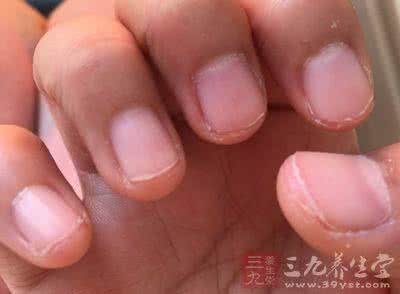 怎样治疗灰指甲有效 怎样治疗灰指甲 这样治疗灰指甲简单有效