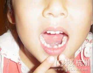小孩换牙期间注意事项 小孩换牙注意事项 换牙期间要怎么护理
