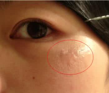 点痣后疤痕增生 点痣后可以用疤痕膏去疤痕吗