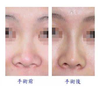 玻尿酸隆鼻效果图 玻尿酸隆鼻效果 玻尿酸隆鼻有效果吗