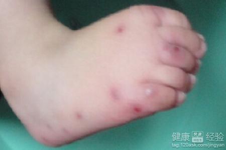 水痘疫苗注意事项 水痘疫苗注意事项 水痘几天好 孩子出水痘家长要注意这些事项
