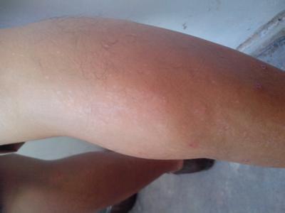 血脂高的症状吃什么好 白癜风的症状 白癜风吃什么好