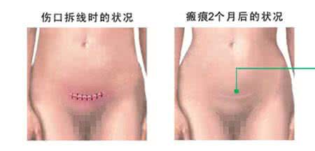 剖腹产后疤痕修复 剖腹产后的疤痕 剖腹产后疤痕修复详解