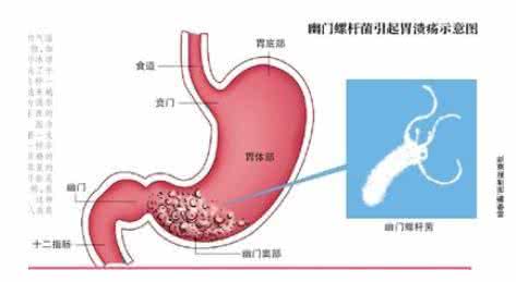 幽门螺旋杆菌阳性原因 幽门螺旋杆菌阳性 幽门螺旋杆菌阳性的原因