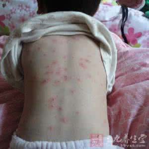 女性为什么会得疱疹 疱疹会传染吗 疱疹引发的疾病