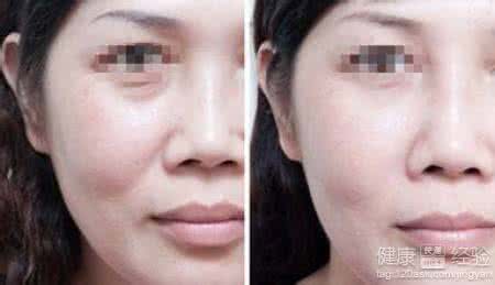 拉皮除皱手术多少钱 拉皮除皱 杨恭如剥皮整容返老返童 现代整容拉皮除皱可以实现