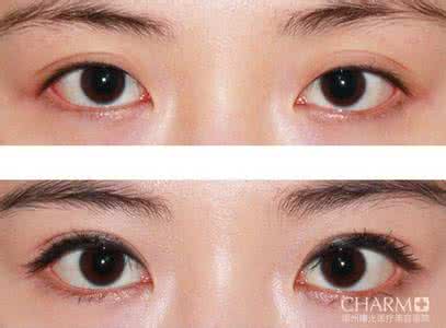做开眼角手术好不好 做开眼角手术好不好 开眼角手术 小眼变电眼