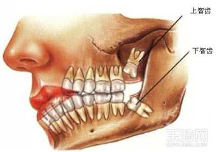 拔智齿视频 智齿一定要拔吗? 需视具体情况而定