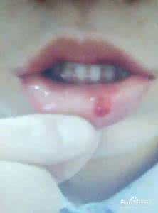 咬破嘴唇导致口腔溃疡 咬破嘴唇导致口腔溃疡 嘴唇发黑是怎么回事 4个原因导致嘴唇发黑