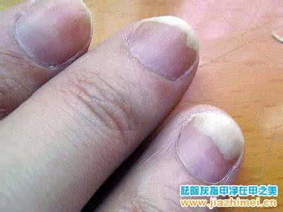灰指甲的初期症状 灰指甲的初期症状 这7个因素让指甲病变