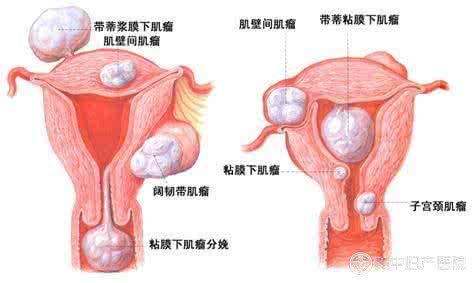 dnf剑魂打团最低伤害 提早发现子宫肌瘤将伤害降到最低