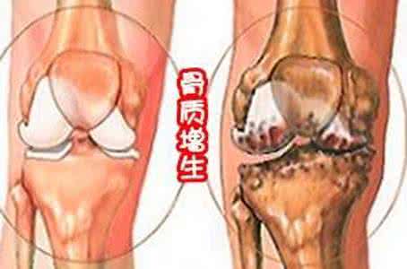 中医治疗足跟骨质增生 骨质增生中医良方-