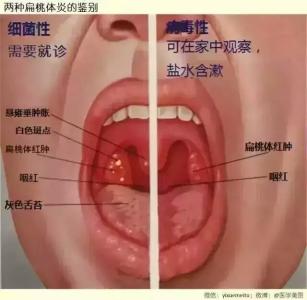 咽炎扁桃体炎症状 咽炎扁桃体炎症状有哪些？怎么区别？