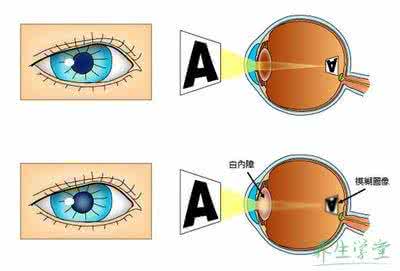 白内障手术视力恢复 如何预防白内障 9种方法还你好视力