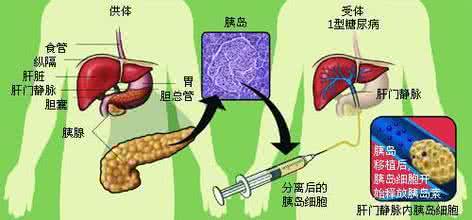 糖尿病能根治吗 糖尿病的根治是梦想还是现实?深度解析！