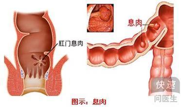 肛门息肉 肛门 息肉 得了肛门息肉怎么办？