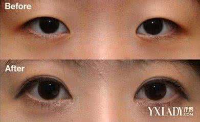 割双眼皮的坏处和后果 割双眼皮的坏处和后果 双眼皮开的太大的后果