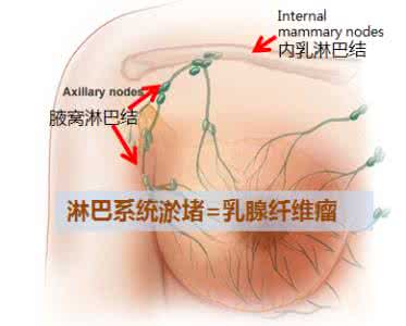 导致乳腺纤维瘤原因 导致乳腺纤维瘤原因是什么