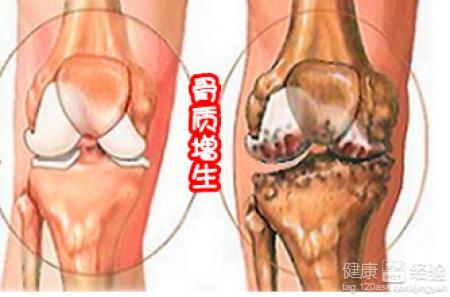 骨质增生的症状及治疗 骨质增生怎么办 骨质增生症状及治疗