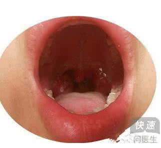 慢性扁桃体炎如何治疗 慢性扁桃体炎 如何治疗慢性扁桃体炎
