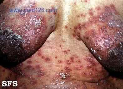 治疗痒疹的快速偏方 妊娠痒疹的表现