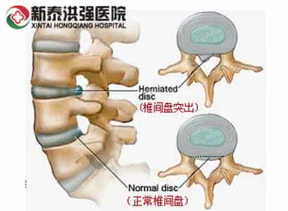 腰椎间盘突出下肢麻木 如何判断下肢麻木是不是源于腰椎间盘突出？