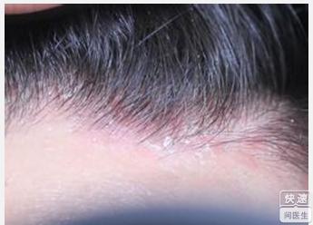 头皮脂溢性皮炎偏方 头皮脂溢性皮炎外用药有哪些