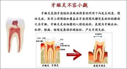 上火牙龈肿痛怎么办 牙龈肿痛—— 两步完成，绝招*