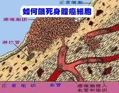 癌细胞为什么杀不死 癌细胞杀不死，保持身体温暖即可防患于未然