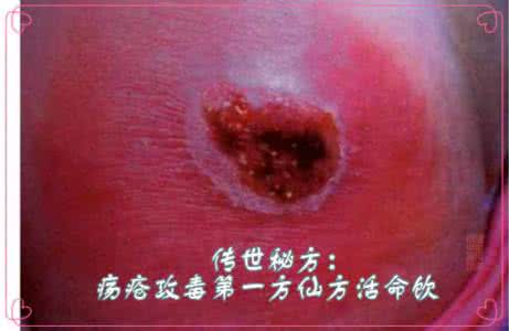 疮疡肿毒 传世秘方:疡疮攻毒第一方仙方活命饮