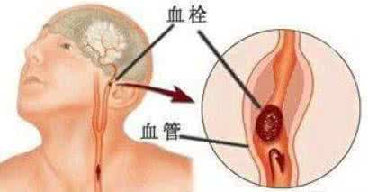 脑梗死急性期 脑梗死急性期 脑梗死急性期有哪些并发症？