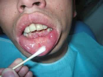 牙龈血管瘤 牙龈血管瘤 惊！牙多黑 血管就有多“黑”