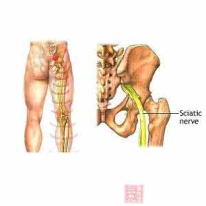 治坐骨神经痛特效秘方 腰腿痛、坐骨神经痛效方