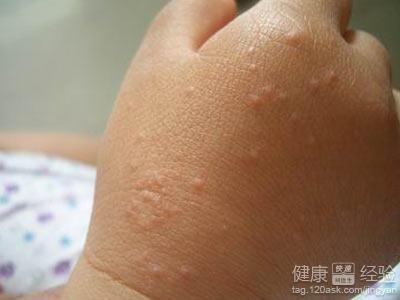 治疗过敏性皮炎小偏方 过敏性皮炎如何治疗 治疗过敏性皮炎用偏方
