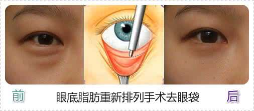 去眼袋最有效的土方法 图说:6种去眼袋最有效的方法