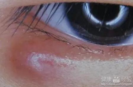 多发性疖肿病因 疖肿的病因 疖肿的症状与治疗