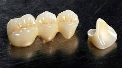 非贵金属烤瓷牙 烤瓷牙 非贵金属烤瓷牙