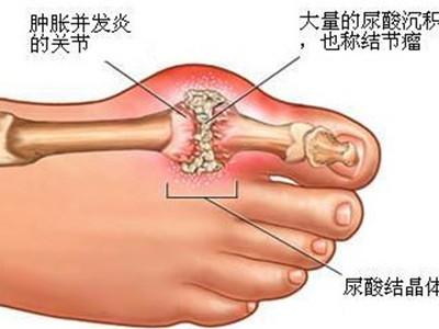 痛风能导致什么病 痛风是怎么回事？