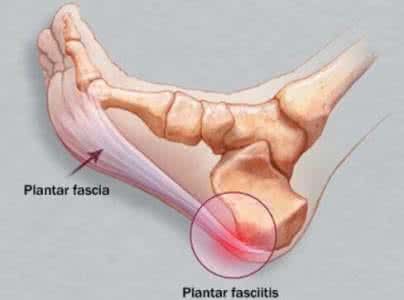 足跟骨刺的治疗方法 足跟骨刺的治疗方法 在家也能治足跟骨刺