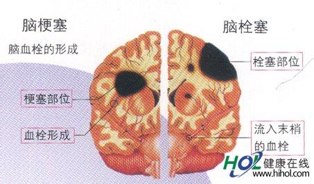 脑血栓和脑梗塞的区别 怎样分清脑出血 脑血栓与脑梗塞