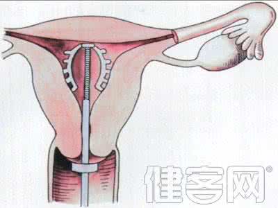 避孕环在子宫放置视频 避孕环在子宫放置视频 上避孕环会导致子宫癌吗