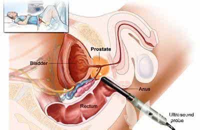 前列腺癌的早期症状 前列腺癌的早期症状 前列腺癌症状
