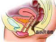 鼻敏感的自愈治疗方法 直肠阴道瘘的自愈方法 直肠阴道瘘的治疗方法