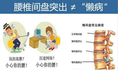 腰间盘突出患者人数 腰间盘突出疼痛怎么办 什么好方法可以让腰间盘突出患者跟疼痛说拜拜！