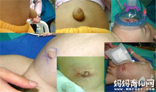 婴幼儿疝气 疝气是什么病?疝气的表现是什么?婴幼儿疝气怎么办?